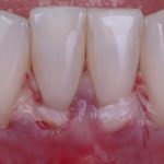 Injerto de tejido blando (Tissue graft)