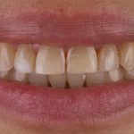 Liquid Veneers antes
