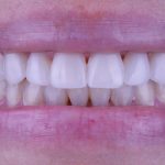 Liquid Veneers despues