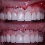Reposicionamiento de labio