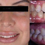 braces