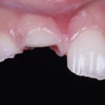 veneers 1 antes