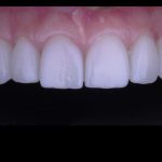 veneers 1 despues