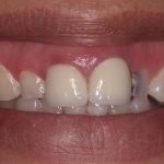 veneers 2 antes