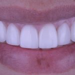 veneers 2 despues