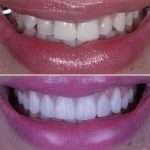 Don’t just consider getting veneers_ go ahead and get THE #ALMONTVENEERS