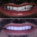 His goal was to enhance his smile_ 10 porcelain veneers was the solution. Patient is always in the driver seat, they get to choose the color and shape. We suggest they decide.