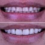 VENEER~1