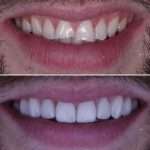 When it comes to PORCELAIN VENEERS_ ALMONT DENTAL has you covered